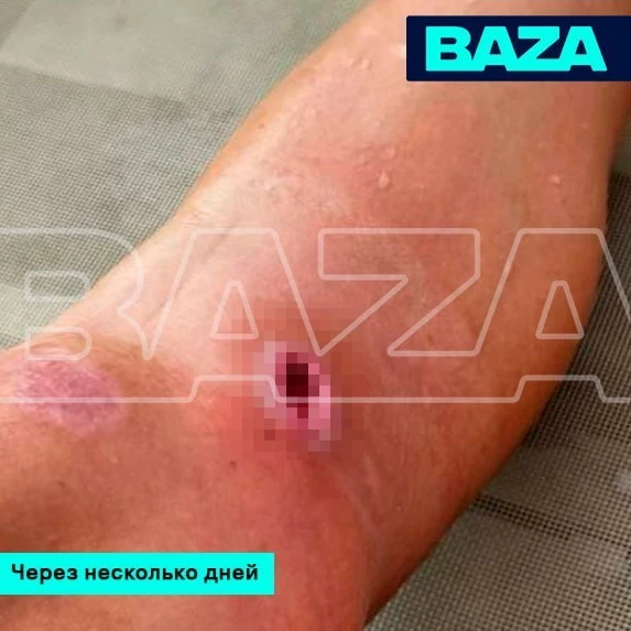 У уроженки Татарстана образовался «кратер» на месте укуса от комара.
