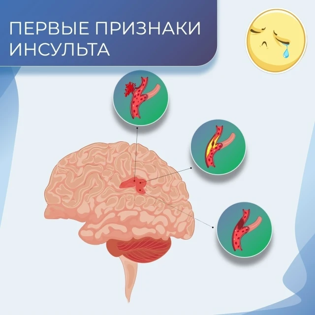 Предвестники инсульта   5 состояний, которые нельзя игнорировать...