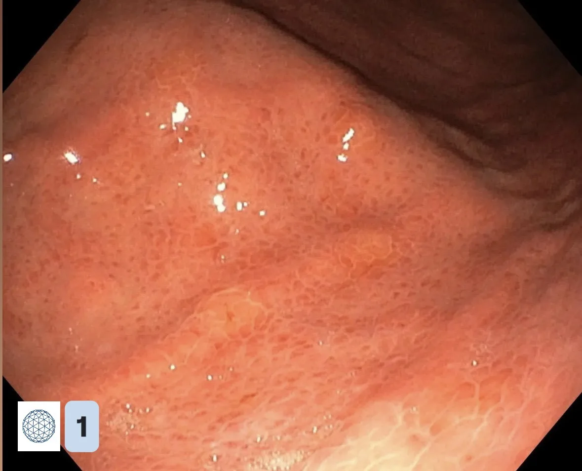 🩺 Helicobacter pylori: как врач-эндоскопист «видит» гастрит во время гастроскопии.

Сегодня делимся