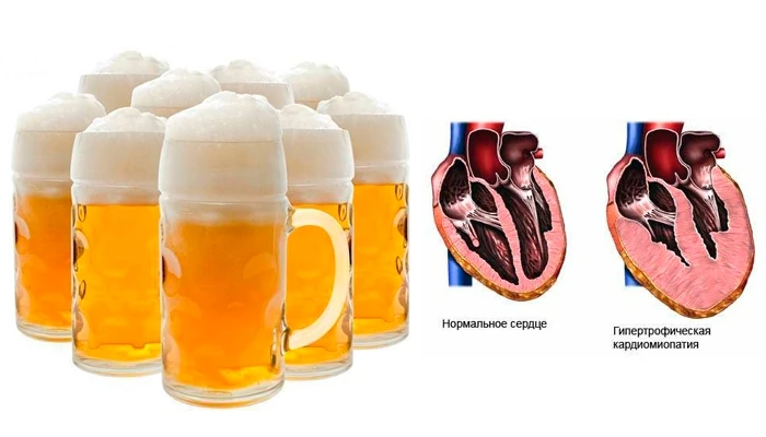 🍺 Любителям пива напомнили о риске «пивного сердца»

Регулярное употребление большого количества ал