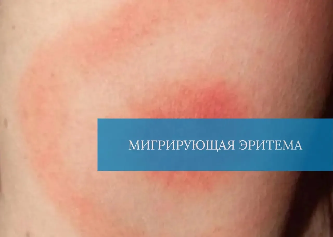 📖Мигрирующая эритема — это не просто пятнышко, которое пройдет само собой. Это классич...