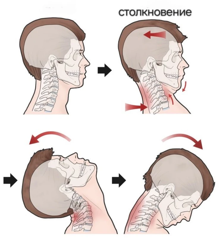 ХЛЫСТОВАЯ ТРАВМА ШЕИ.