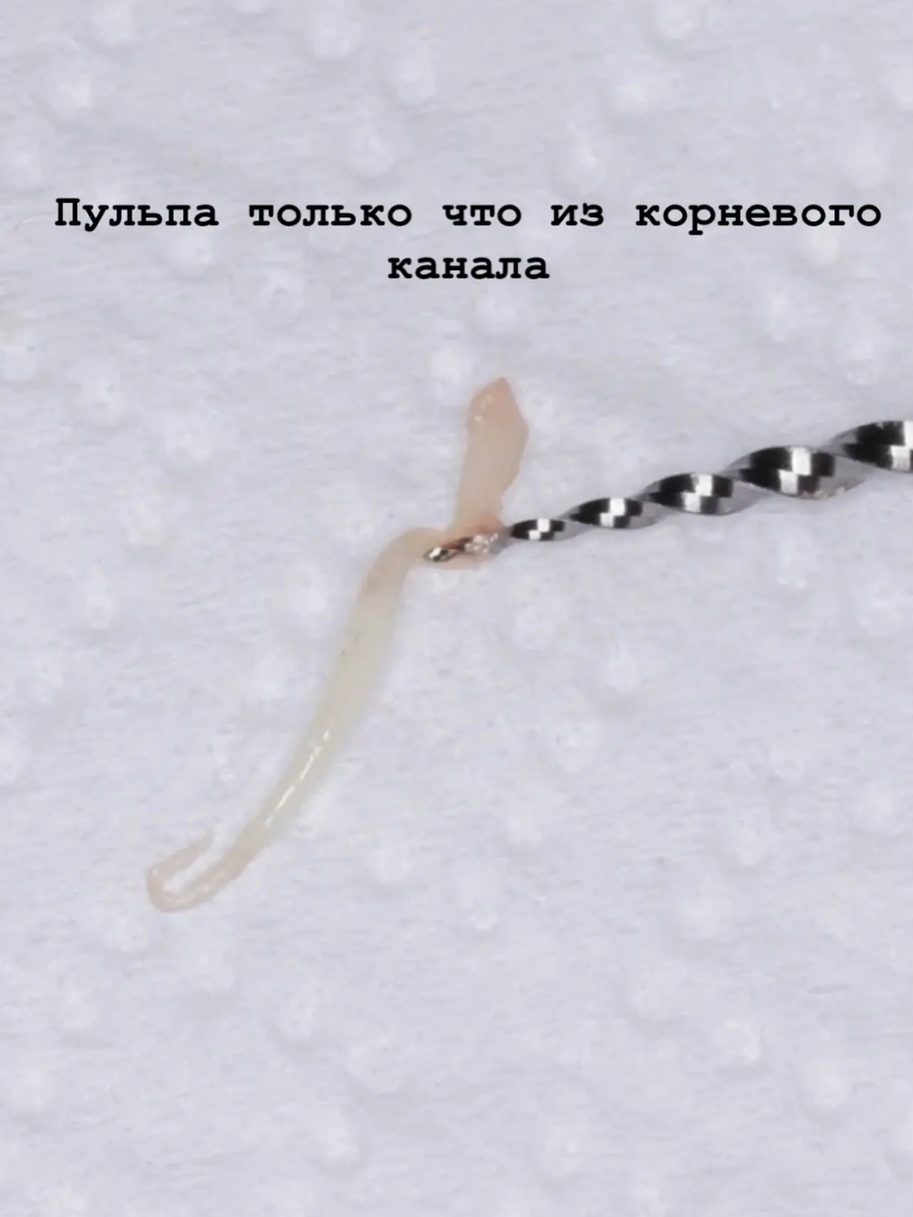 ✨Пульпа просто была в гипохлорите, без активации.