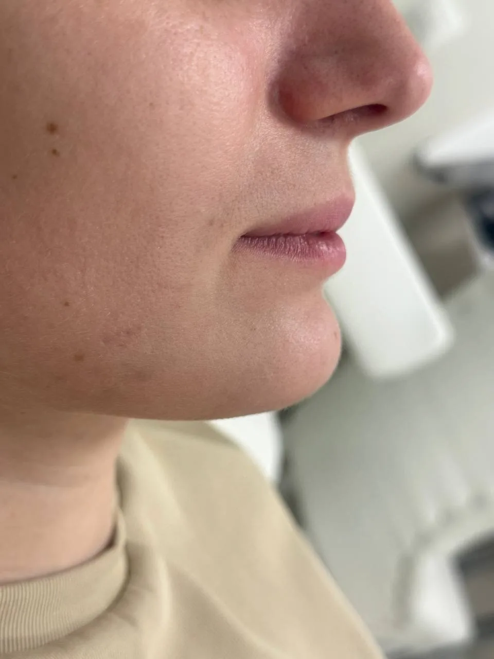 ДО/ПОСЛЕ

Контурная пластика губ Belotero lips shape 0,6 мл

На самом деле, я обожаю работать с есте