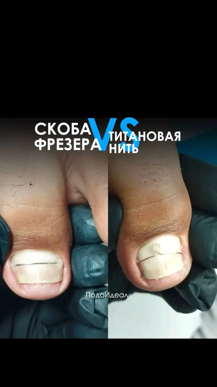 Скоба Фрезера/Титановая нить