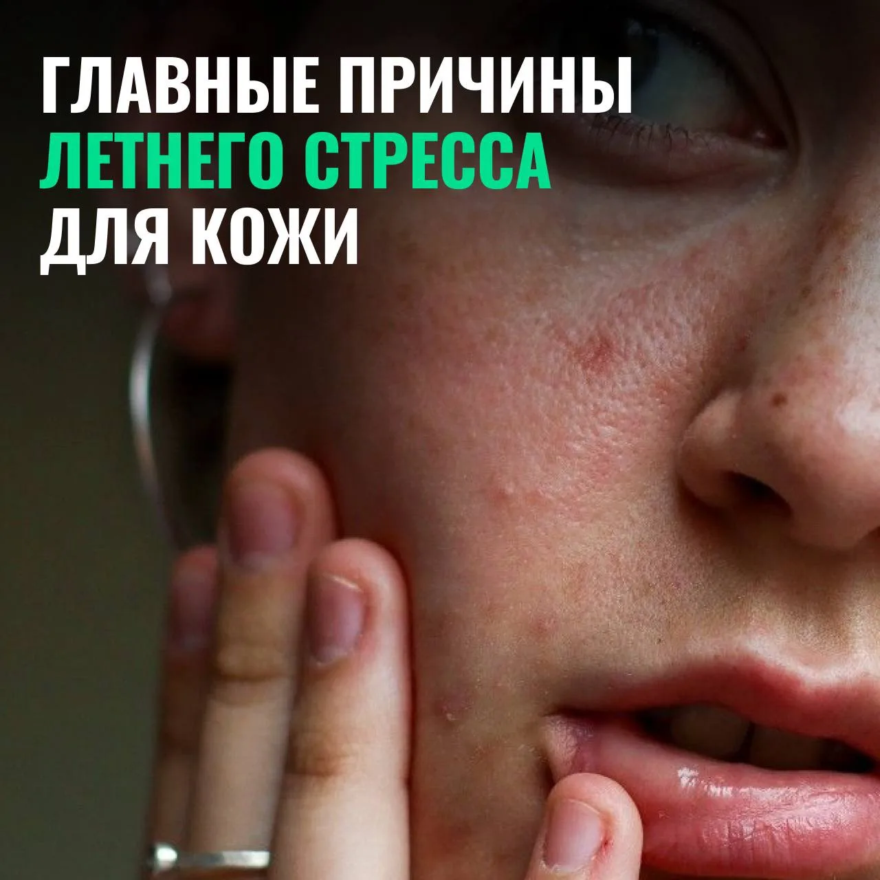 Парадокс лета — кожа одновременно жирнится и сохнет. Жара усиливает работу сальных желёз, но при это