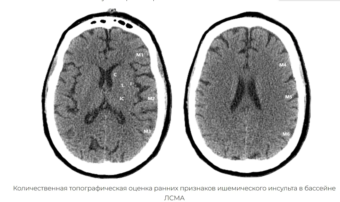 Подборка полезных шкал по КТ головного мозга🧠

📝Шкала ASPECTS: http://xray-doctor.ru/shkala-aspect