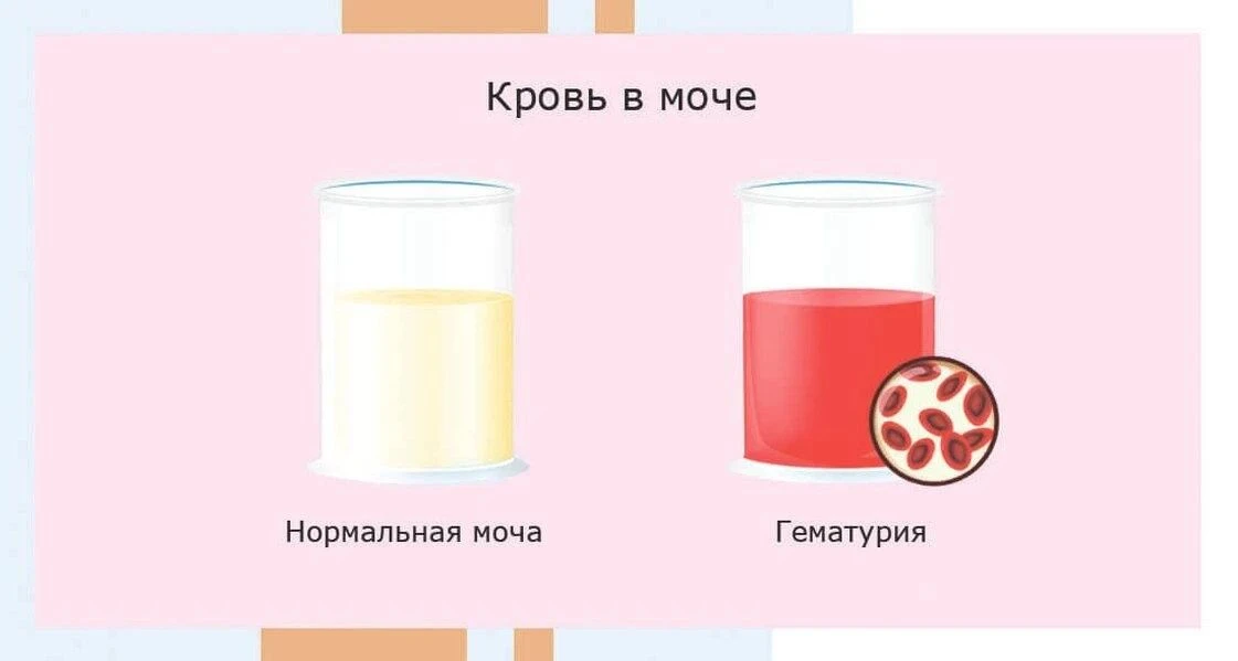 Почки — это парный орган размером с кулак, который играет жизненно важную роль в поддер...