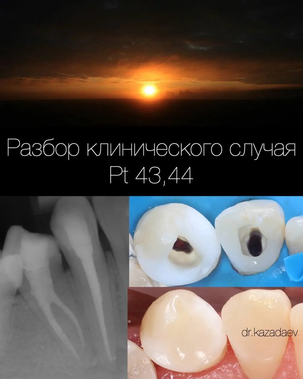 Новый кейсообзор. Pt 43, 44. Интересная анатомия обоих зубов