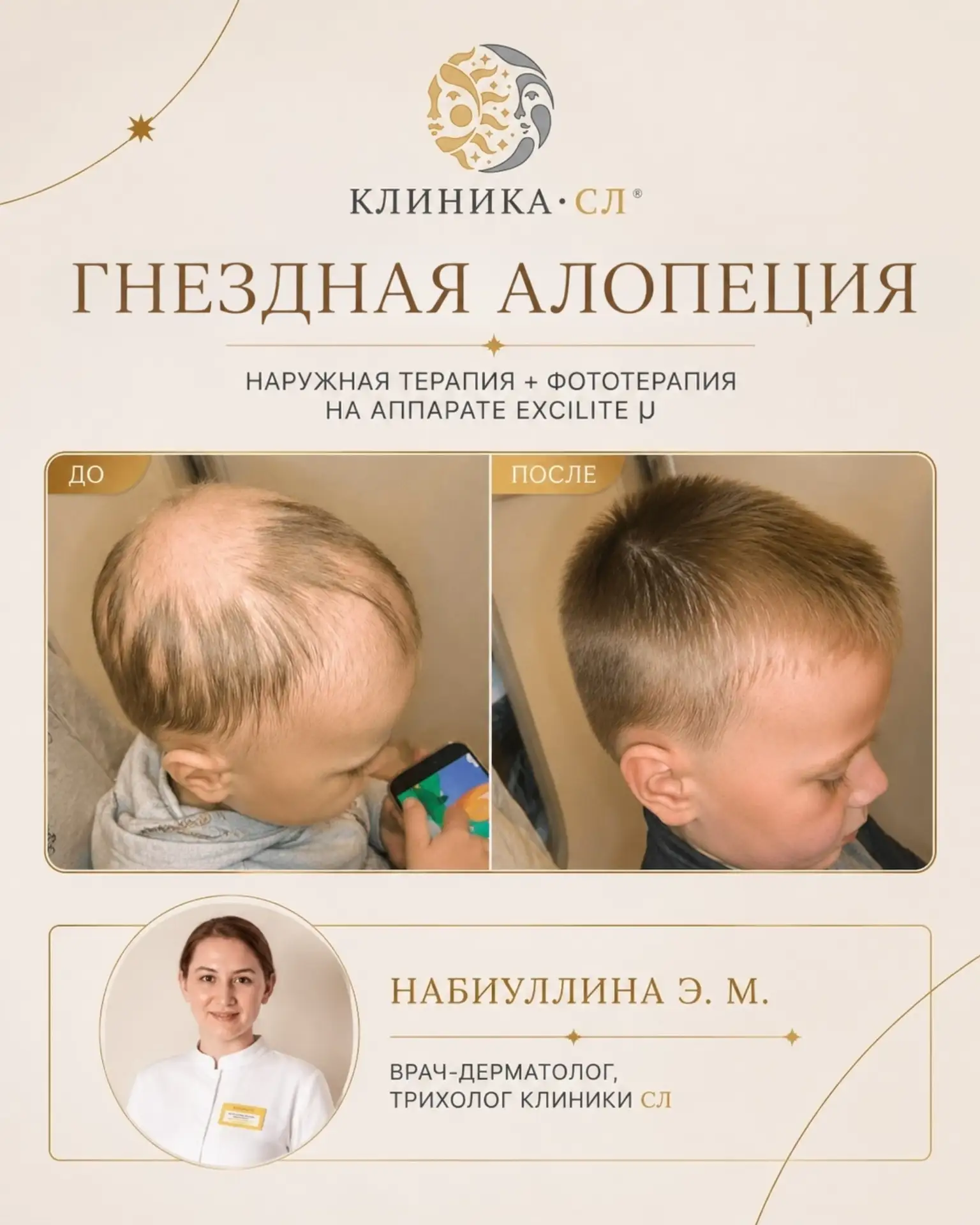 Гнездная алопеция у ребёнка: результат лечения спустя 9 месяцев