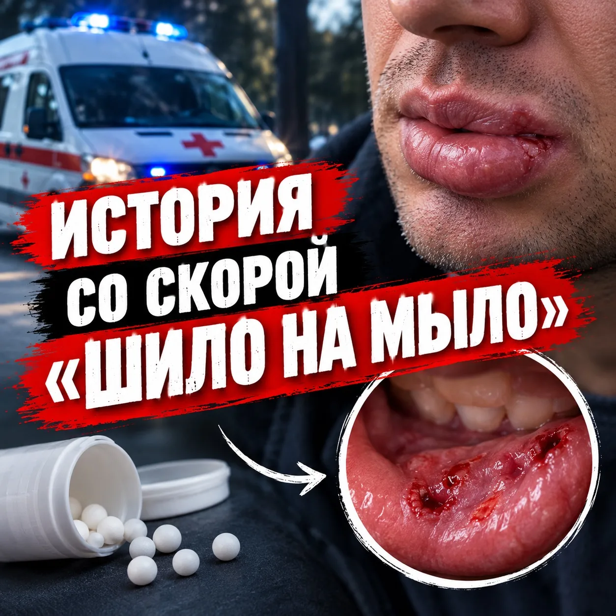 Повод к вызову скорой помощи: сильно распухла, губа болит.