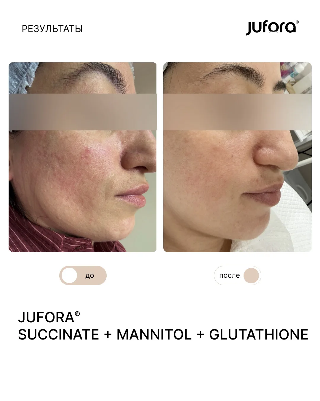 Показываем потрясающий результат после курса мезотерапии JUFORA® SUCCINATE + MANNITOL +...