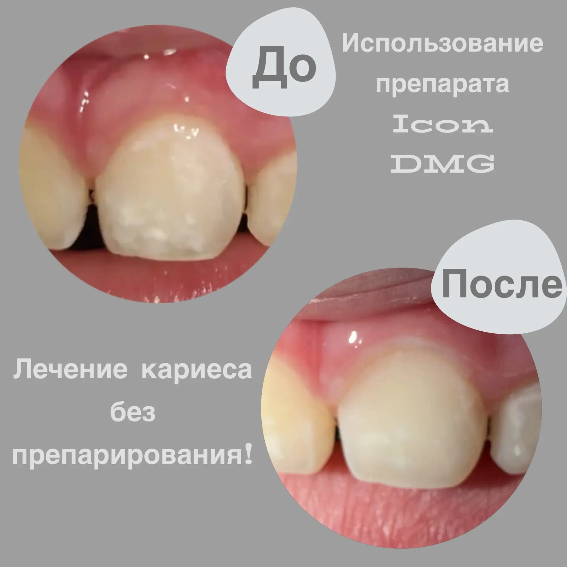 Ранний кариес выглядит как ,,меловидное’’ пятно. Его лечение на начальном этапе — лучша...