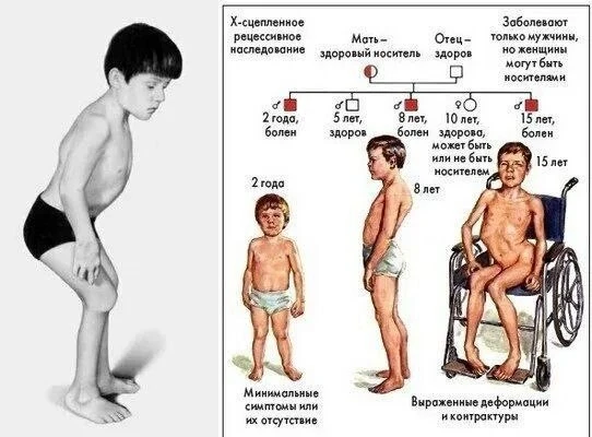 ✅ 7 сентября - Всемирный день распространения информации о мышечной дистрофии Дюшенна.
