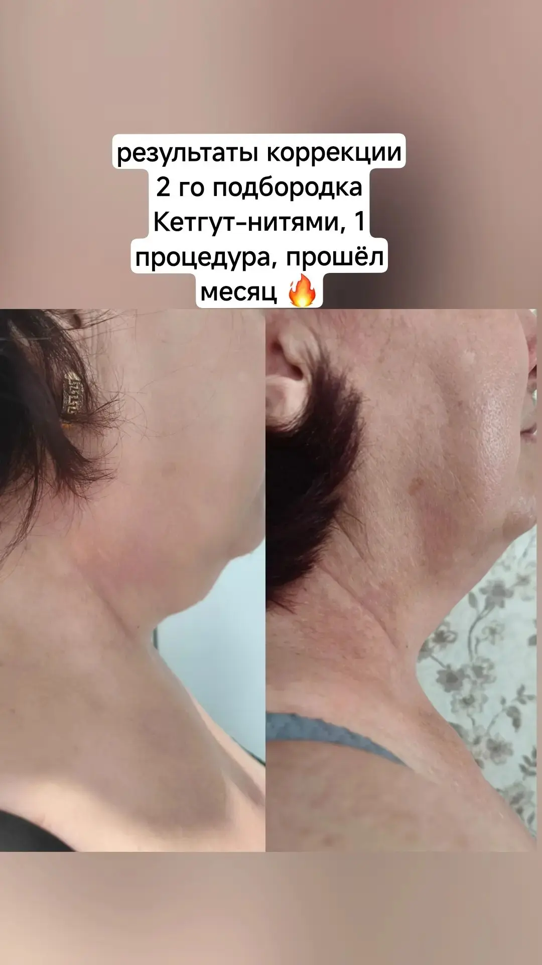Кетгут-нити ⚡️Второй подбородок. Четкий контур за 1 сеанс.