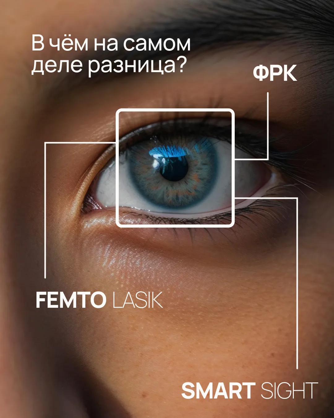 ФРК, Femto LASIK или SMARTSIGHT: в чём на самом деле разница?