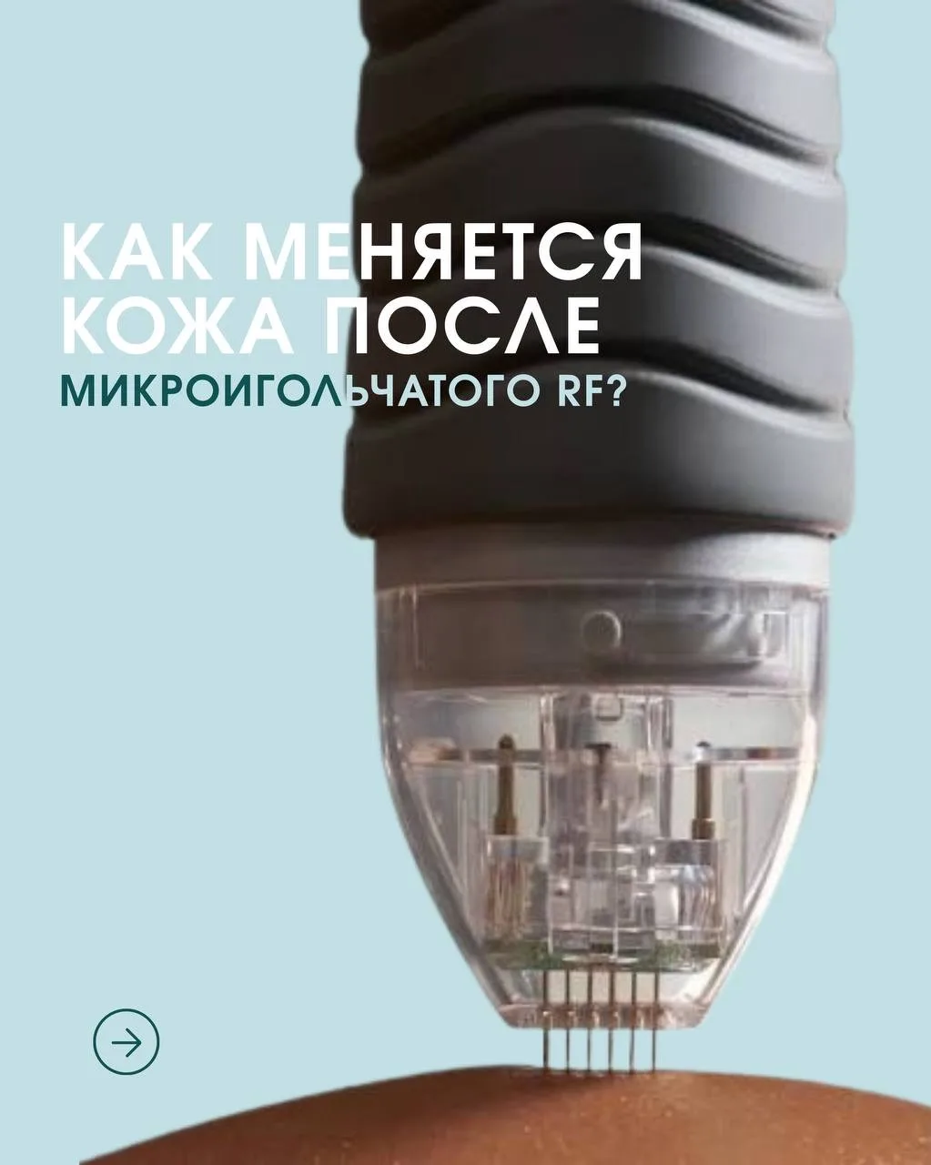Микроигольчатый RF-лифтинг — это не процедура с мгновенным и кратковременным эффектом.

После воздей