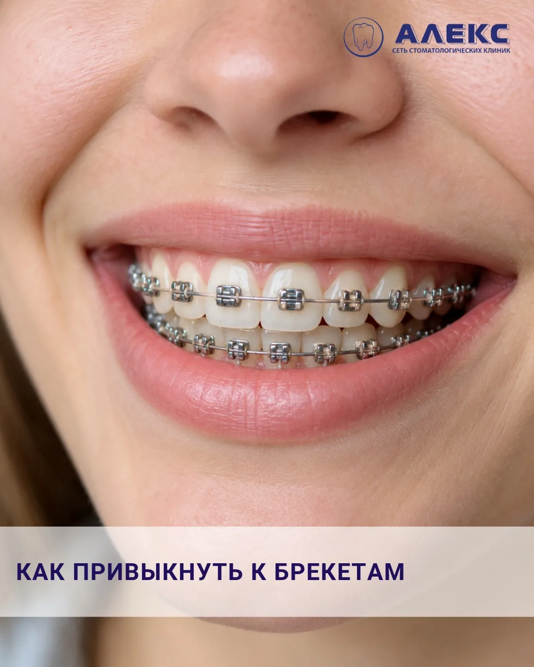 Как привыкнуть к брекетам?
