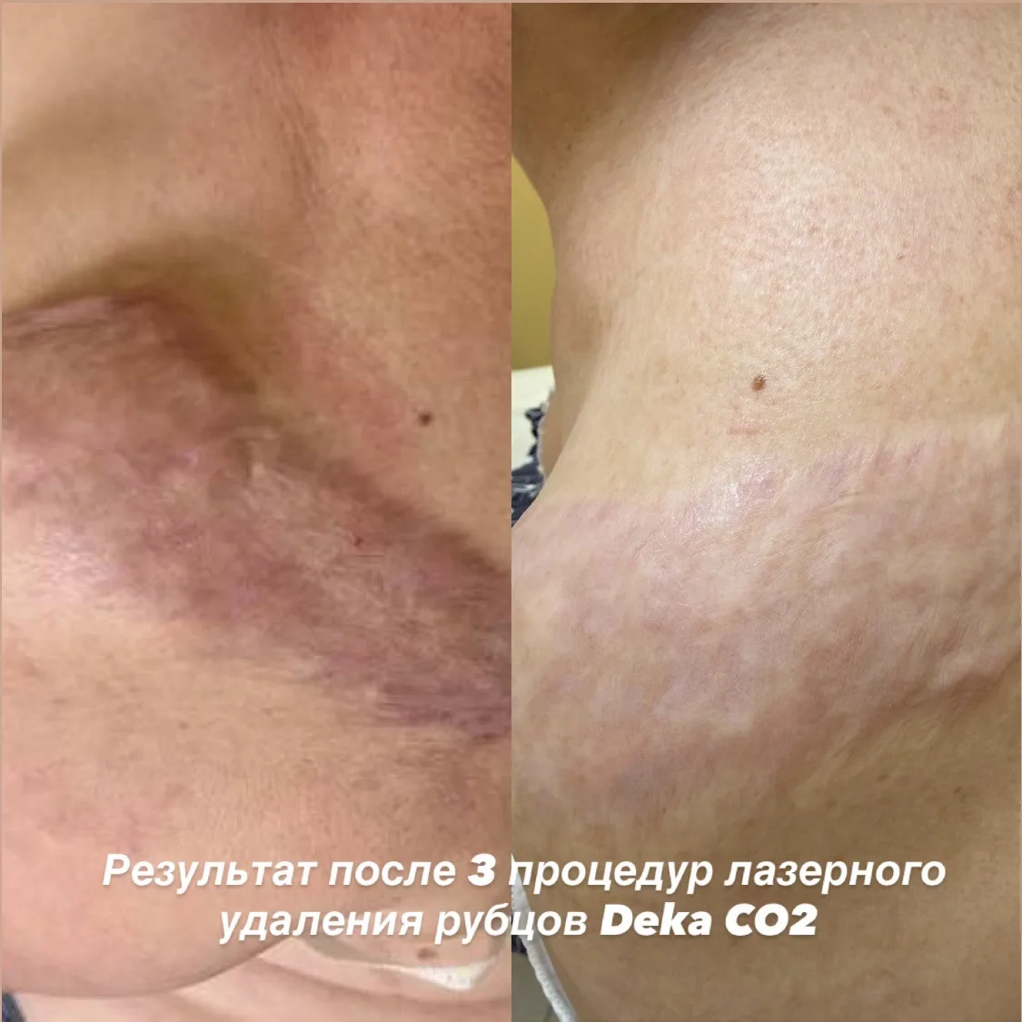 Растяжки и шрамы не проходят от кремов! Но это не значит, что с ними ничего нельзя сделать