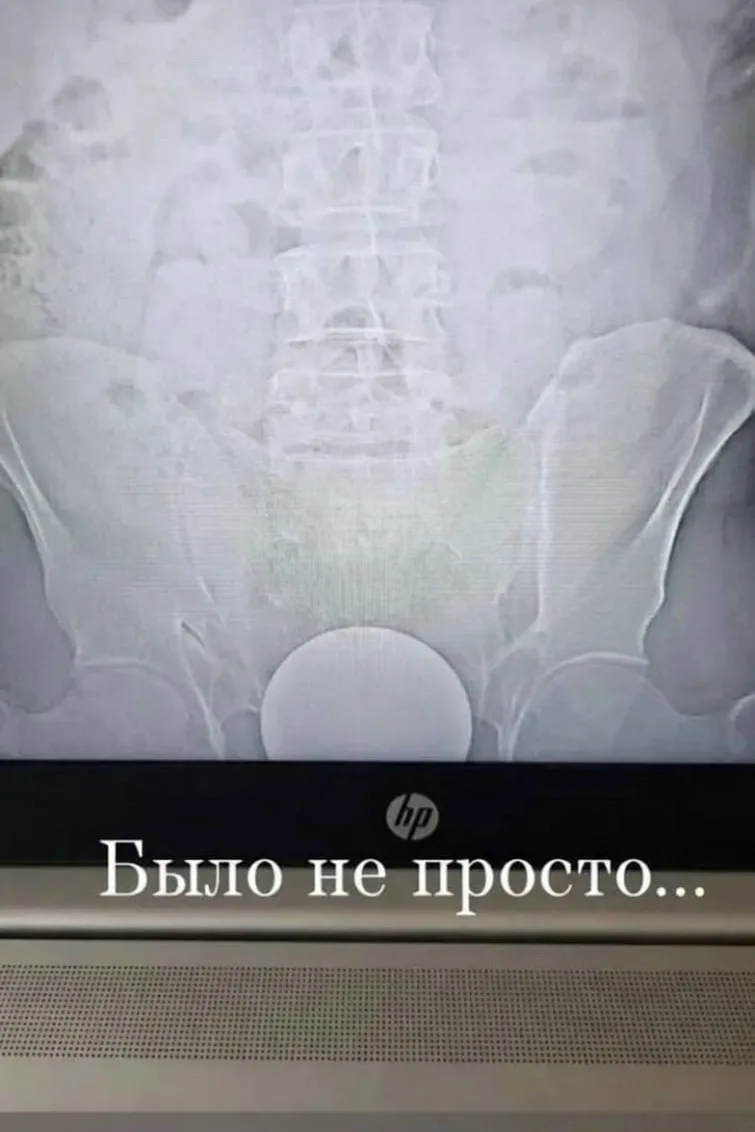 Очередной энтузиаст анальных экспериментов пополнил статистику курьёзных госпитализаций...