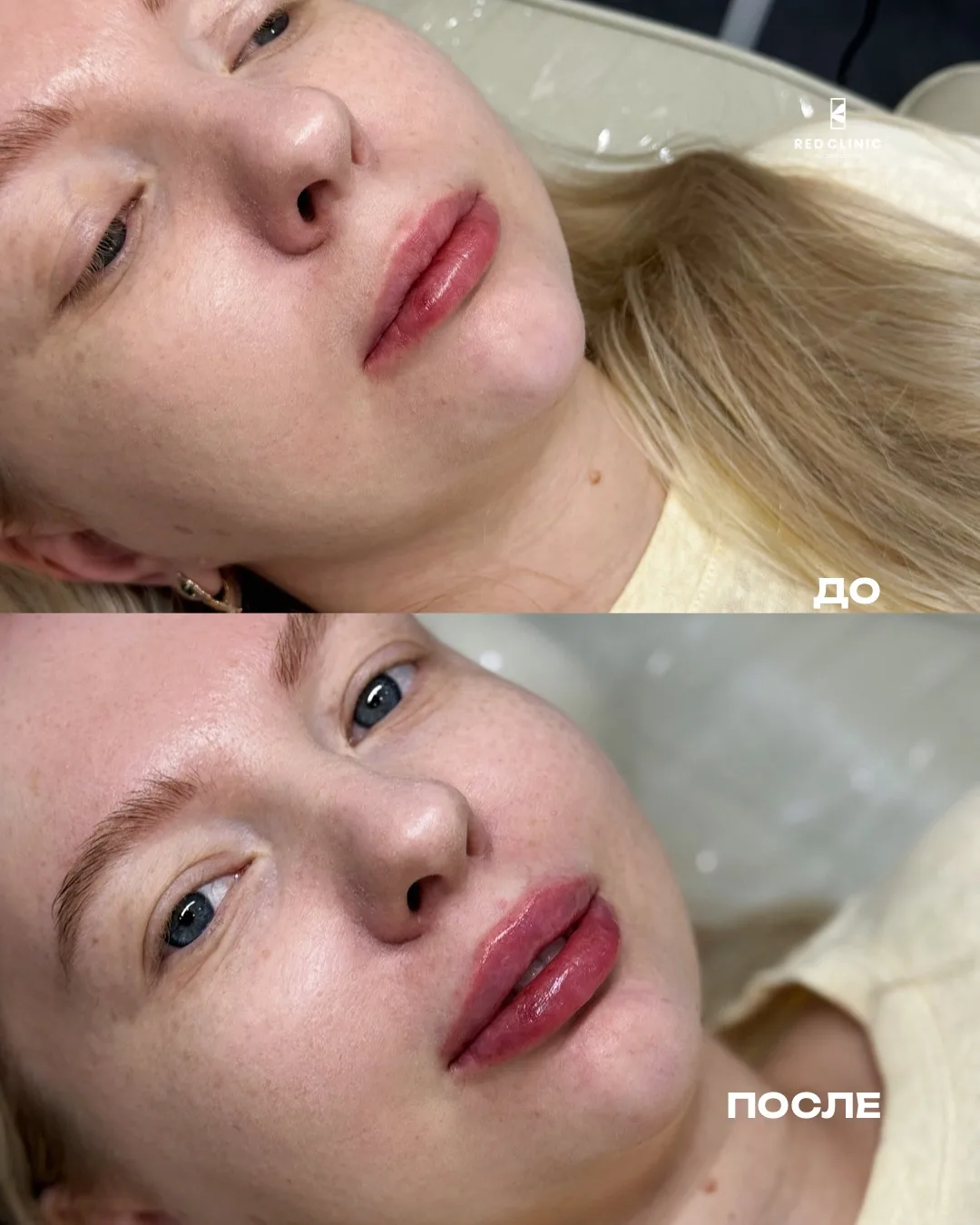 Губы ДО / ПОСЛЕ 💋