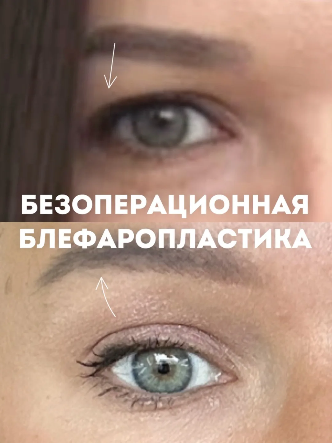 ПОДНЯЛИ НАВИСШИЕ ВЕКИ БЕЗ ОПЕРАЦИИ🔥