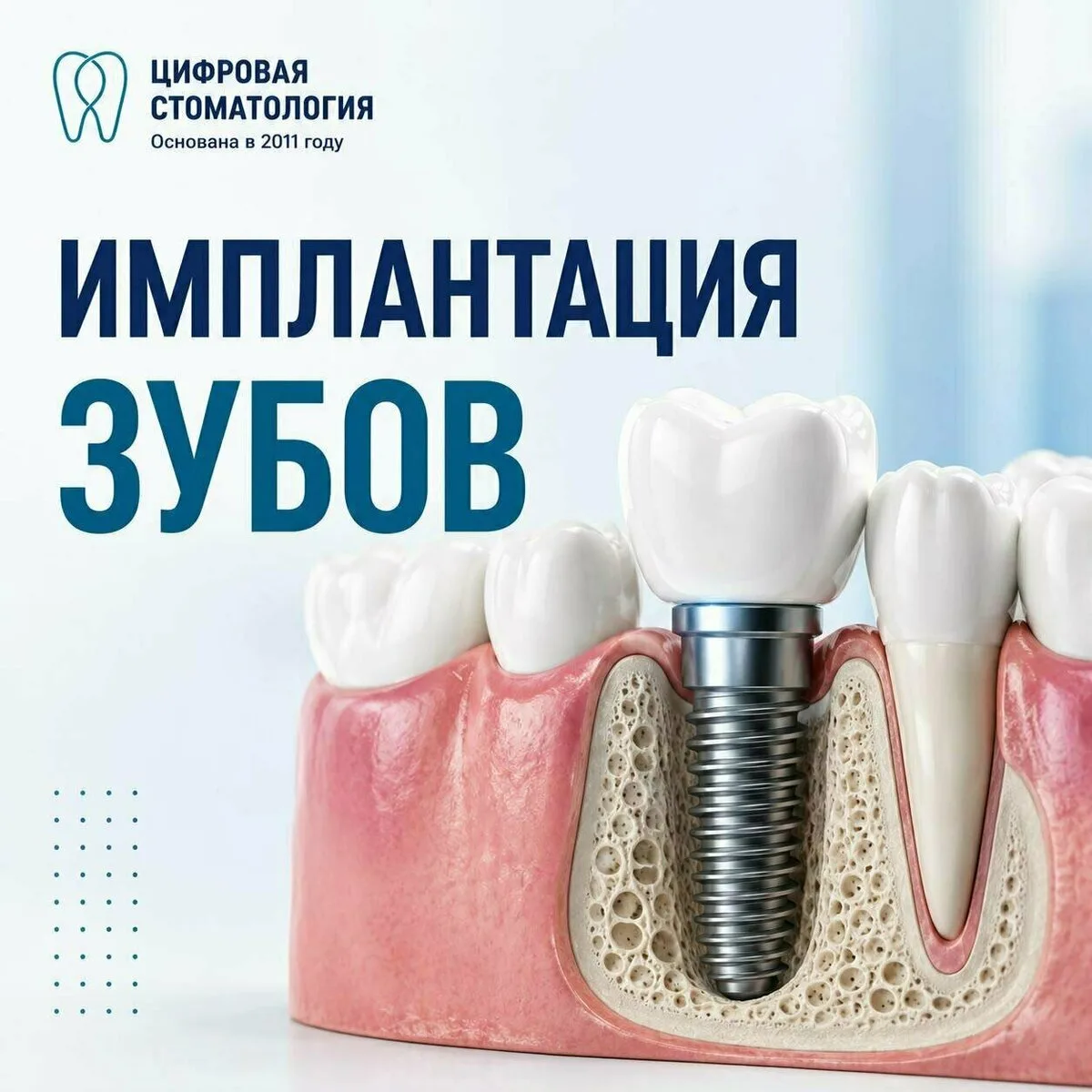 Имплантация зубов по технологии ALL-ON-4 в Анапе!