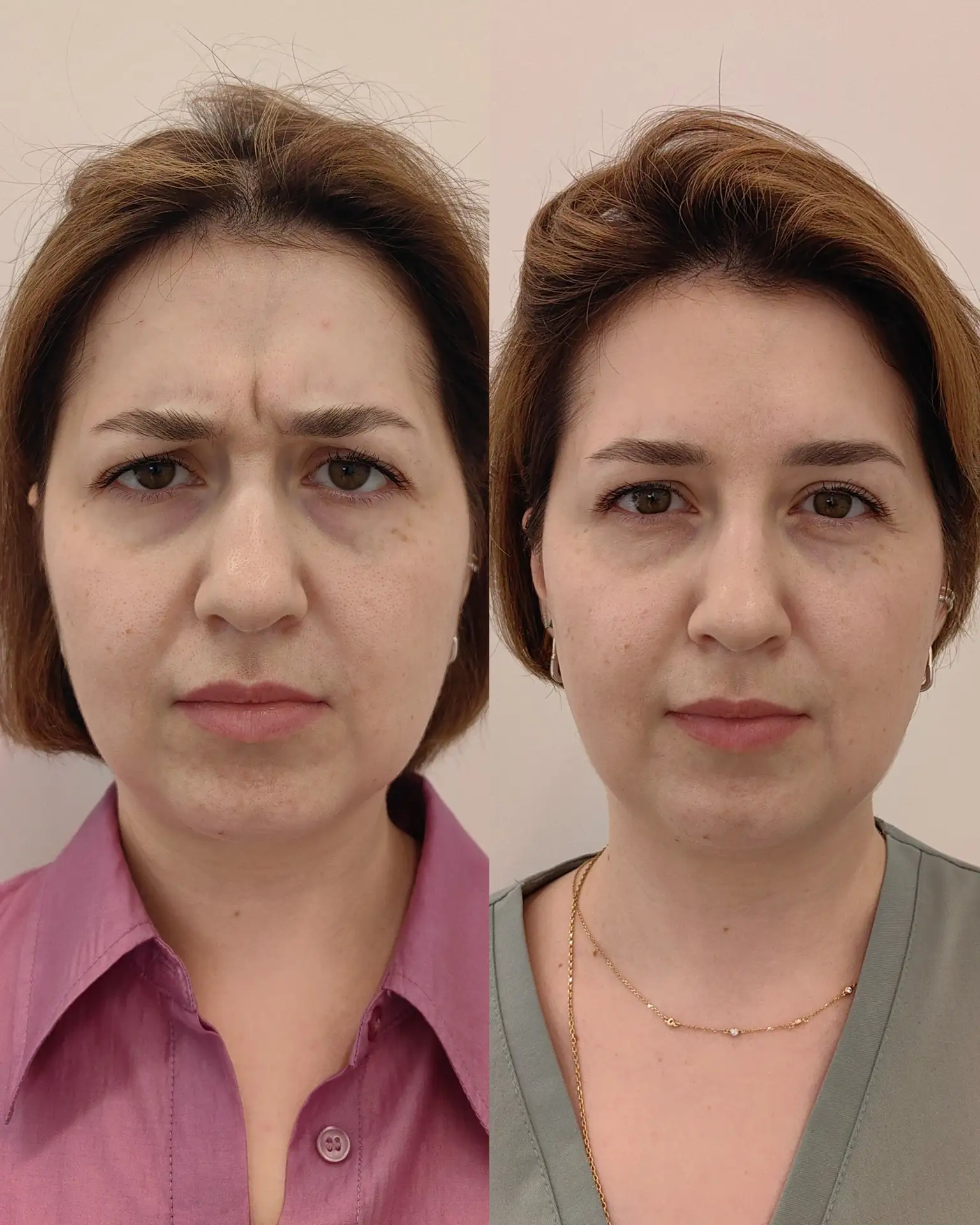 Вы замечали, что хмуритесь даже тогда, когда не злитесь?