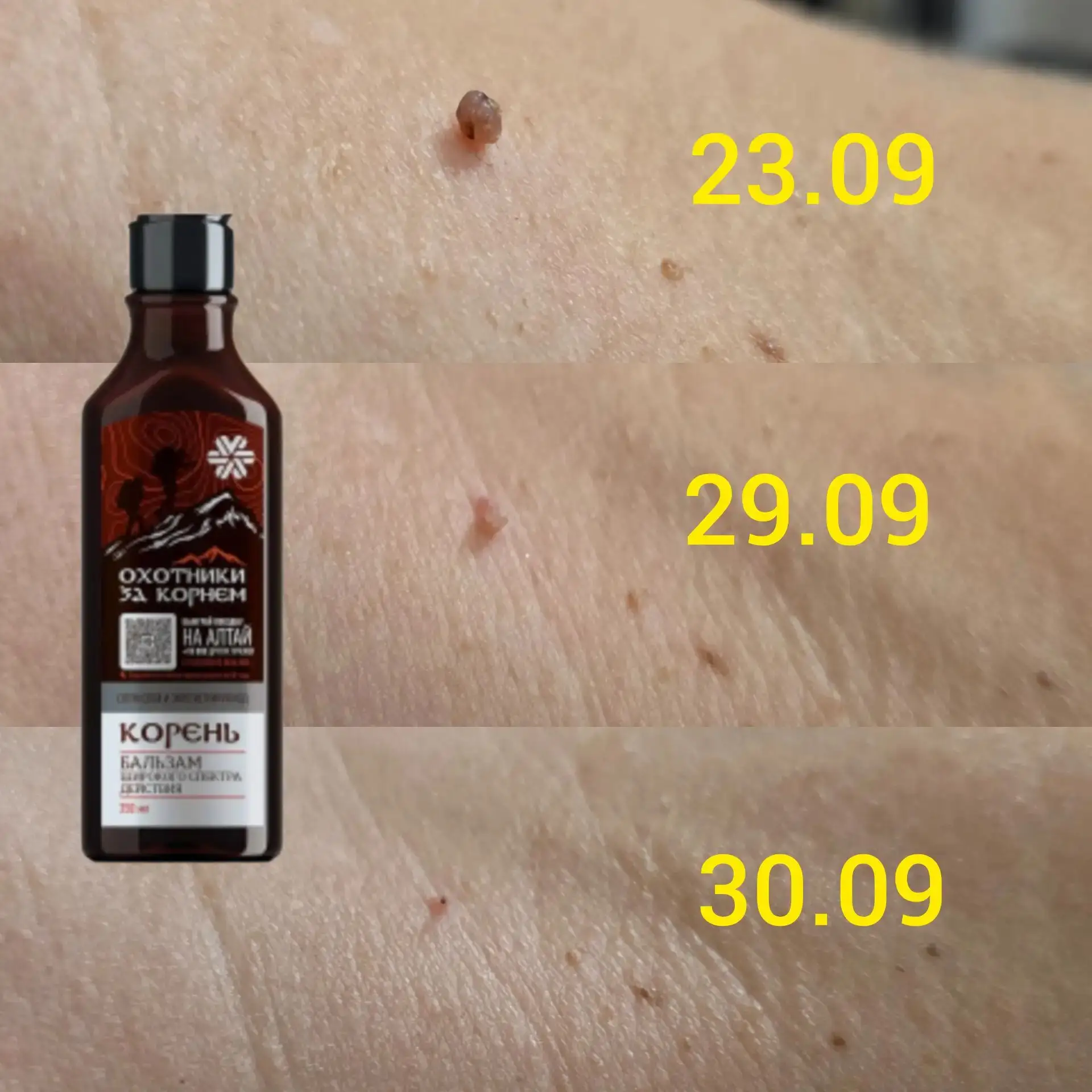 Посмотрите, что делает этот продукт,были попиломы на шее у женщины ) результат видите с...
