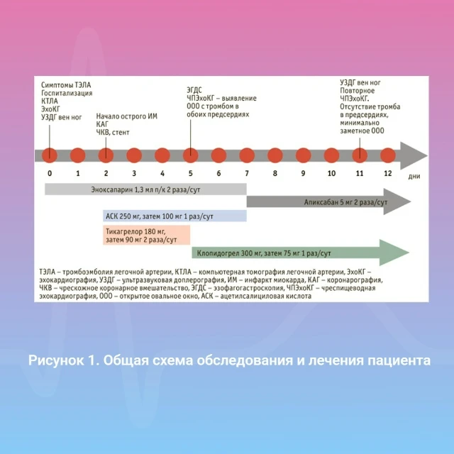Инфаркт миокарда вследствие парадоксальной эмболии после ТЭЛА на фоне венозного тромбоз...