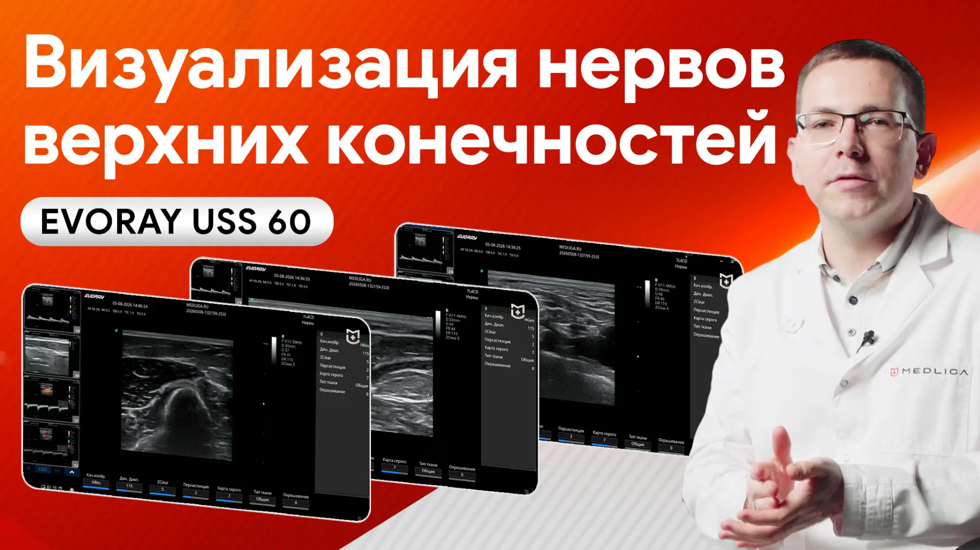 ❗️EVORAY USS 60: УЗИ нервов верхних конечностей в практике врача

УЗИ нервов верхней конечности на E