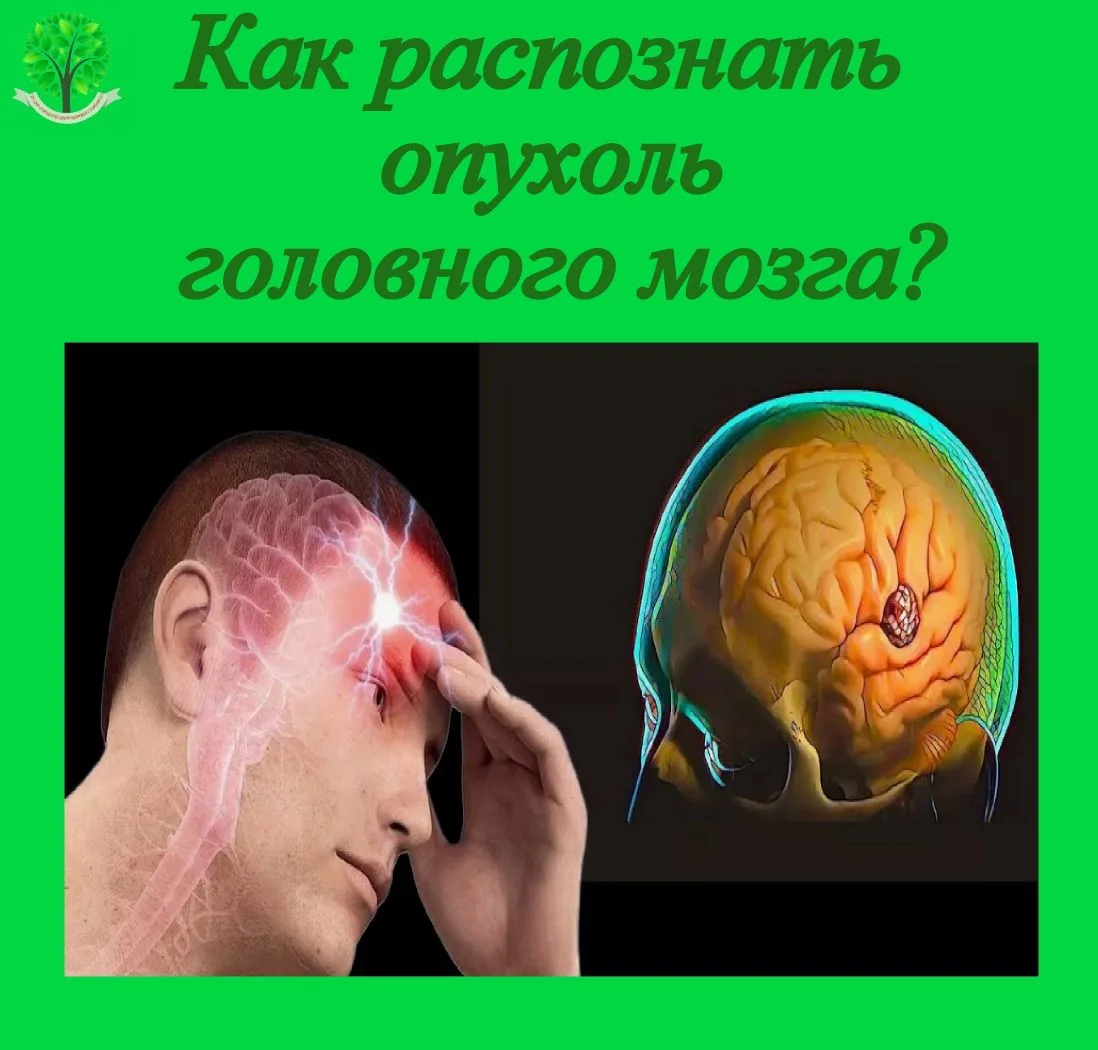 О СИМПТОМАХ ОПУХОЛИ ГОЛОВНОГО МОЗГА