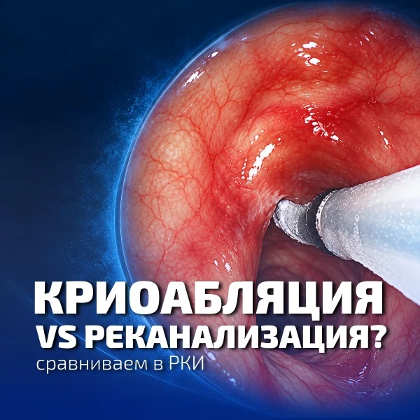 Криореканализация или криоабляция при эндобронхиальном туберкулёзе