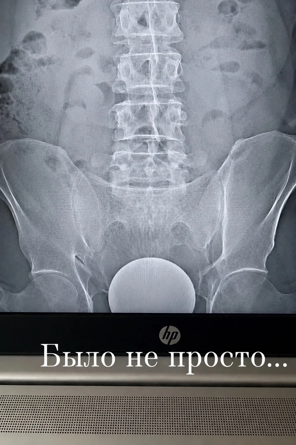 Парень попытался убедить врачей, что стеклянный шар диаметром 10😱 см телепортировался ...