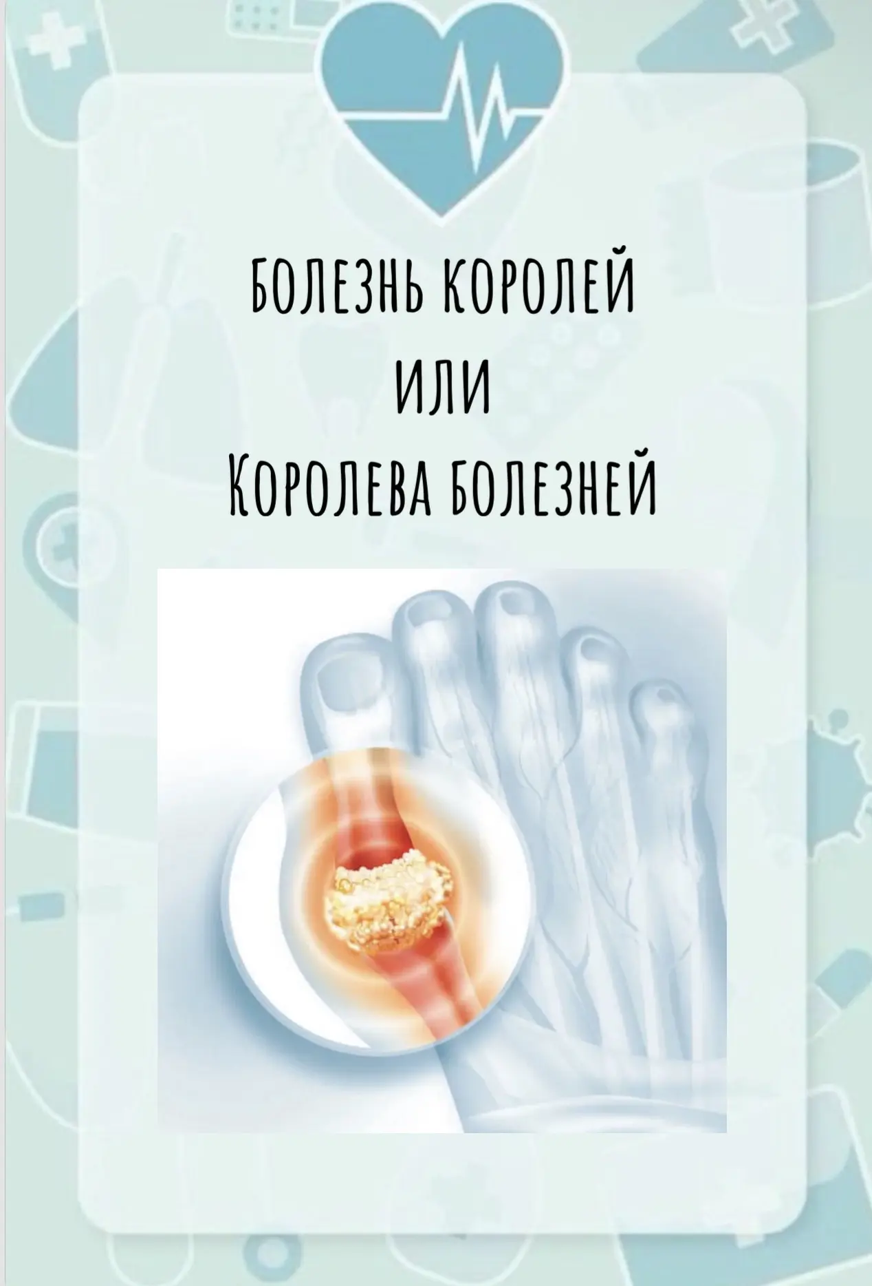 БОЛЕЗНЬ КОРОЛЕЙ или КОРОЛЕВА БОЛЕЗНЕЙ

Издавна, ПОДАГРУ считали "болезнью королей", потому что связы