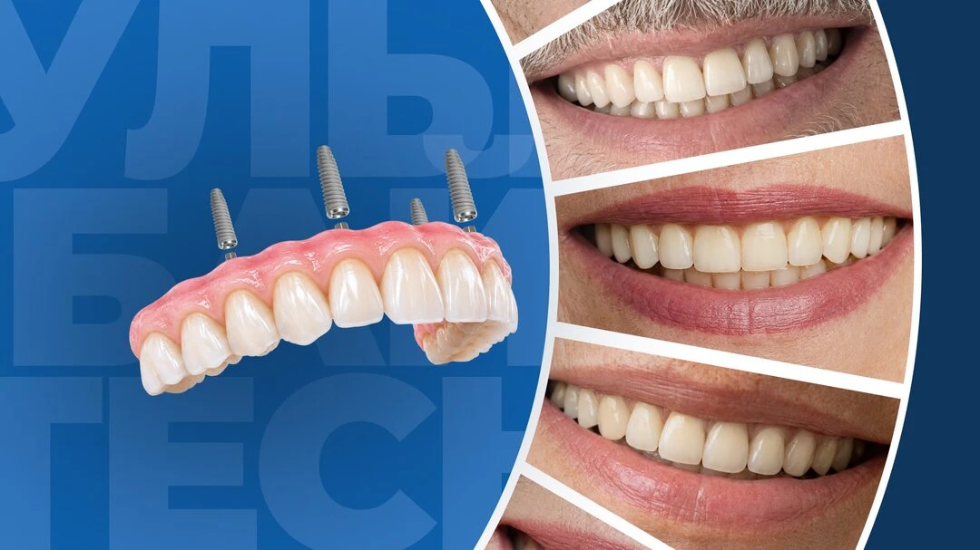 Протезирование сразу всех зубов челюсти на 4х имплантах!