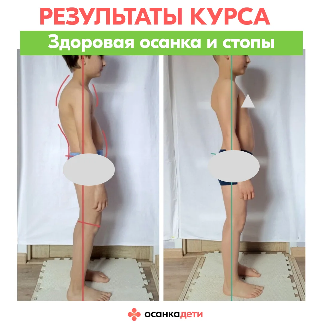 Его «до» — это стельки, «рукопашка» и ….  сутулость. После — смотрите в карусели результаты Савелия 