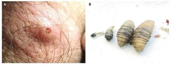 ⭐️ Дерматобиаз при поражении личинками Dermatobia hominis  Дерматобиаз – это паразитарное заболевани