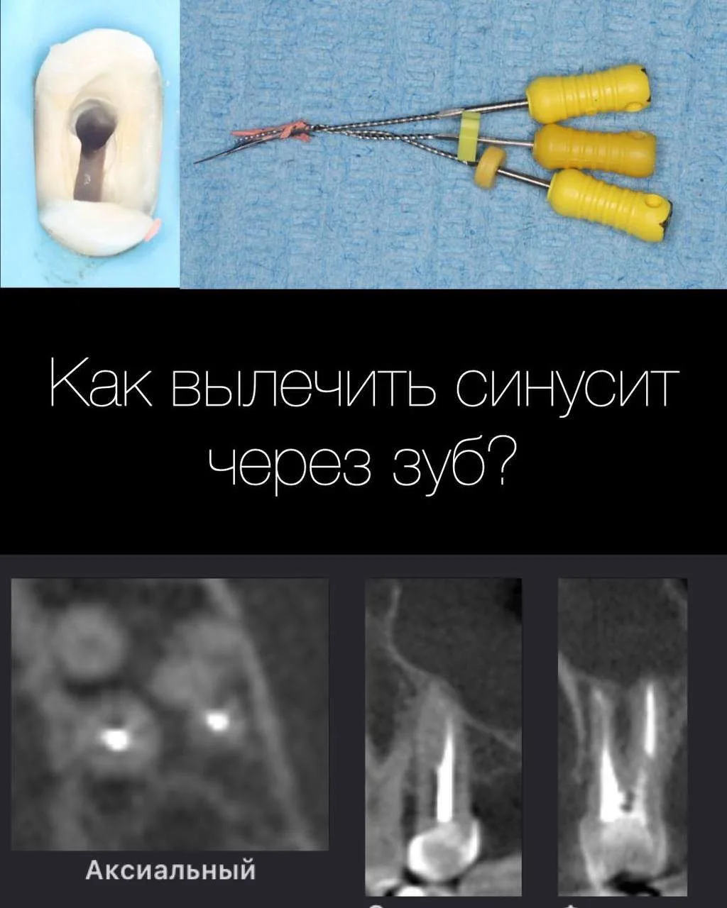 ✨Лечение одонтогенного синусита по средствам лечения хр.апик.перидонтита 25. Лечение было в 1 визит.