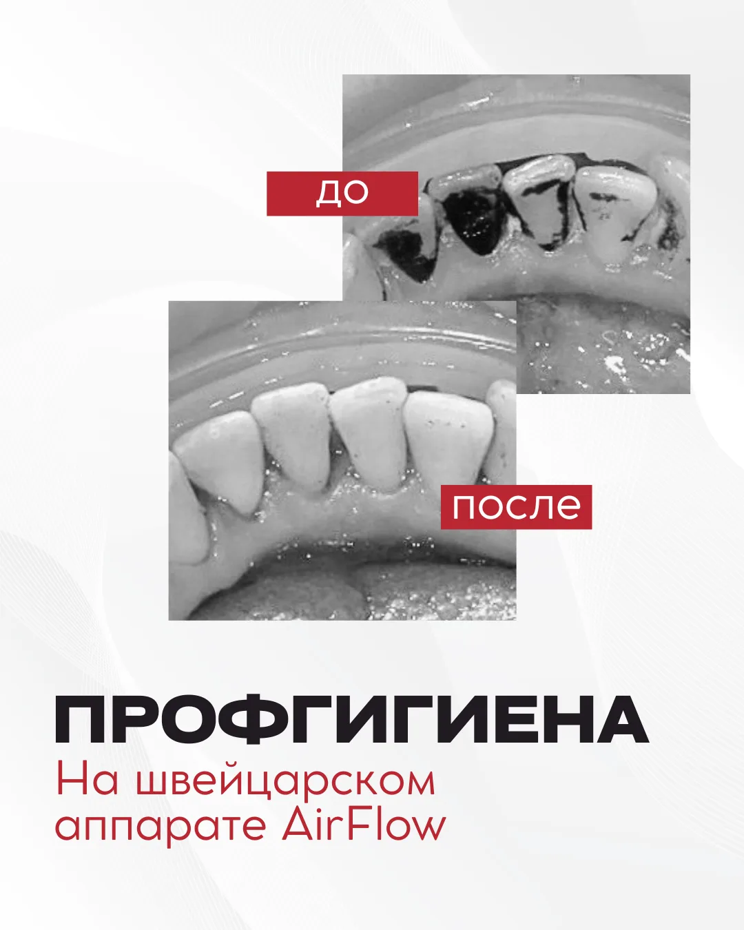 Деликатная гигиена зубов