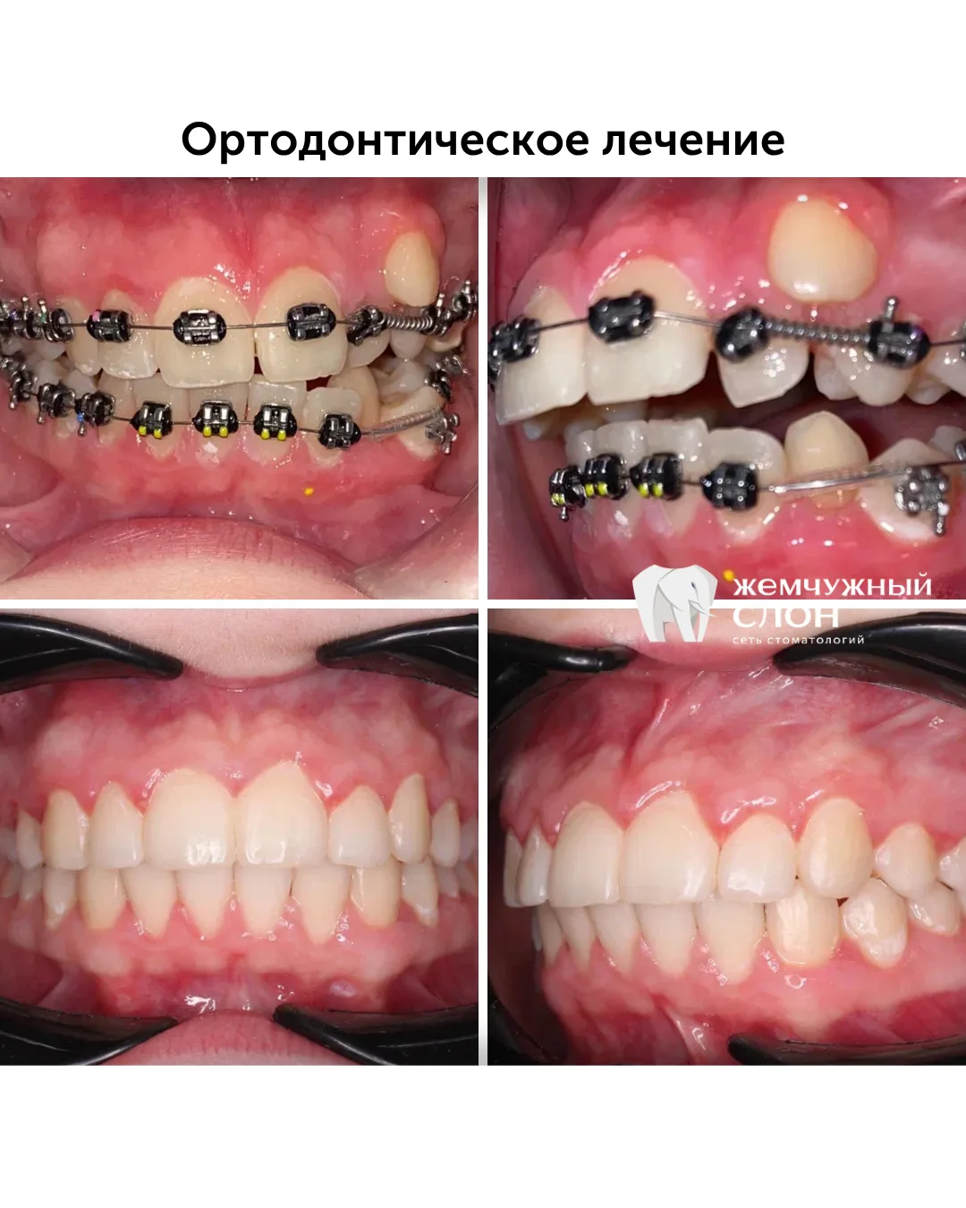 Если верхние и нижние зубы смыкаются неравномерно, нагрузка при жевании распределяется ...