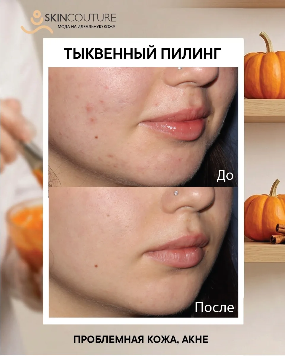 Если хотите избавиться от черных точек и прыщей, а взамен получить чистую кожу попробуй...