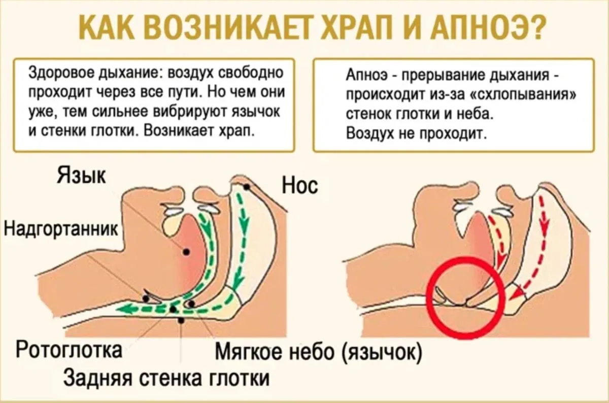 Из-за чего мягкое небо становится слабым? ➡️Передавливаются нервы, которые проходят в передних дужка