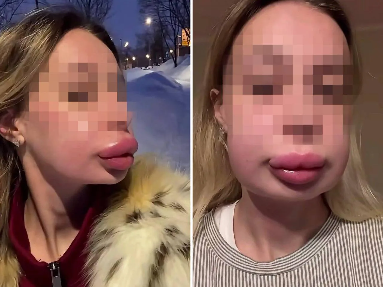 👄 Москвичка получила отёк Квинке после удаления филлера