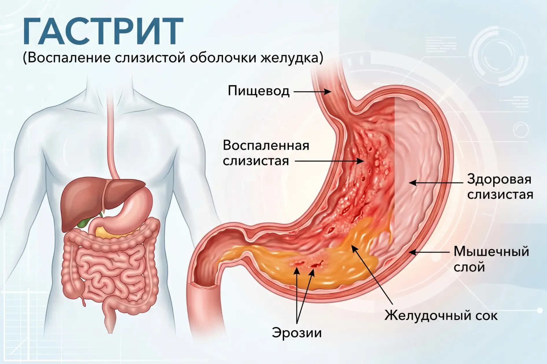Гастрит есть у всех? Это опасный миф, который может стоить Вам здоровья 🩺
