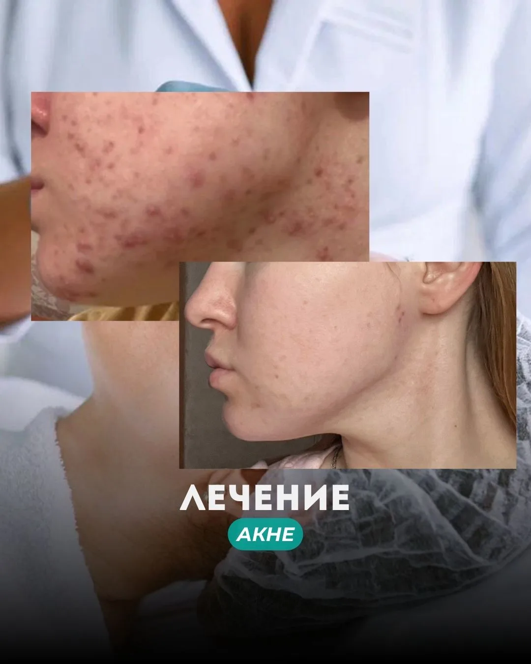 Акне — это проблема, которая может  появиться в любом возрасте и нередко становятся при...