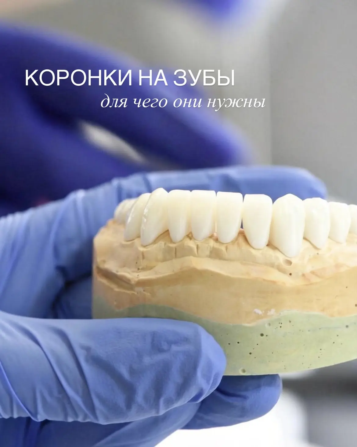 Керамическая коронка — это способ сохранить сильно разрушенный зуб, когда обычная пломб...