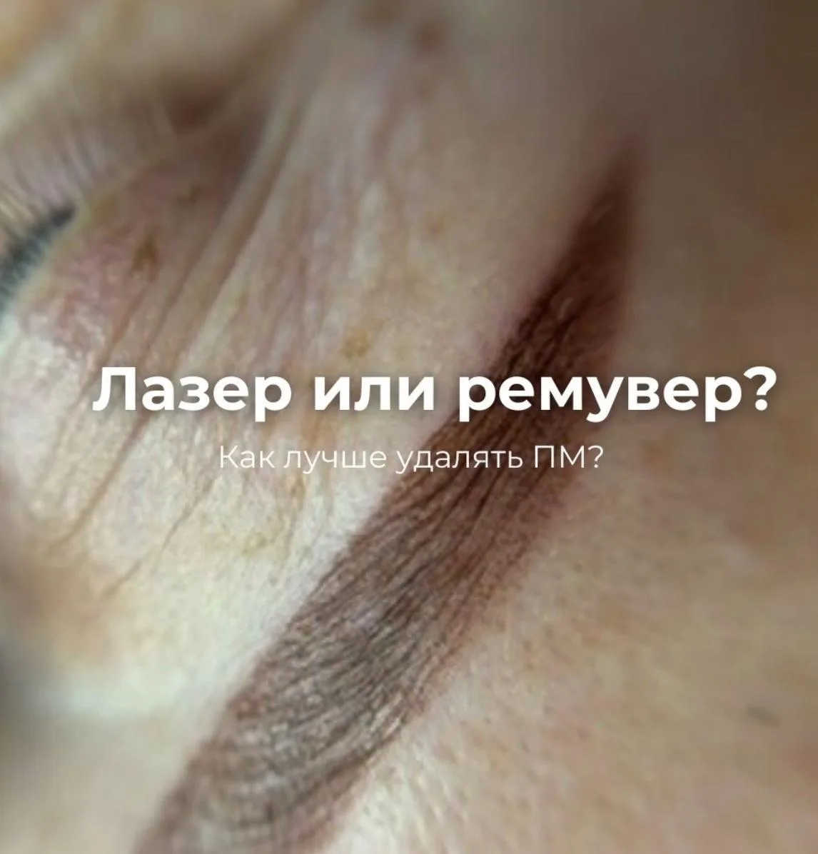 Лазер или ремувер?
