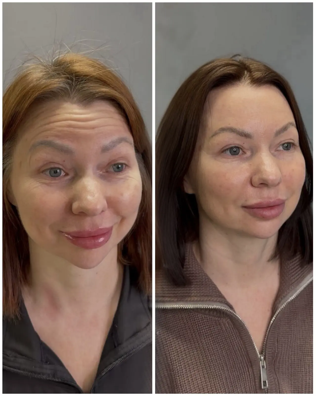 Результат ботулинотерапи верхняя треть лица👸🏽Стоимость такой процедуры 8000 р.