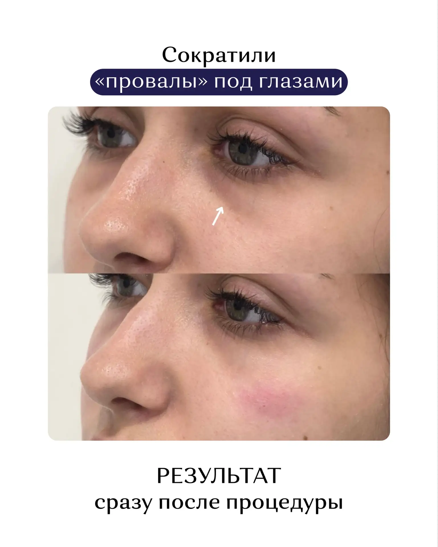 УБРАЛИ ВЫРАЖЕННЫЕ «ПРОВАЛЫ» ПОД ГЛАЗАМИ 👏